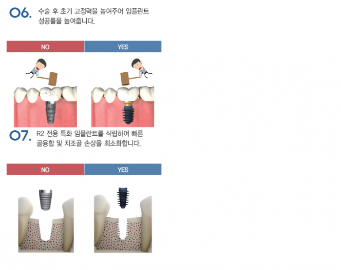 R2임플란트_설명7.PNG