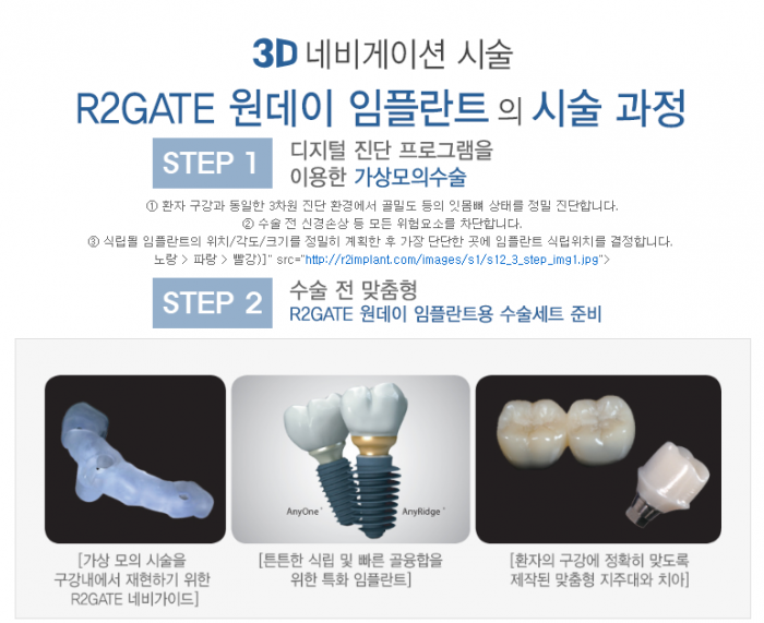 R2임플란트_설명8.PNG