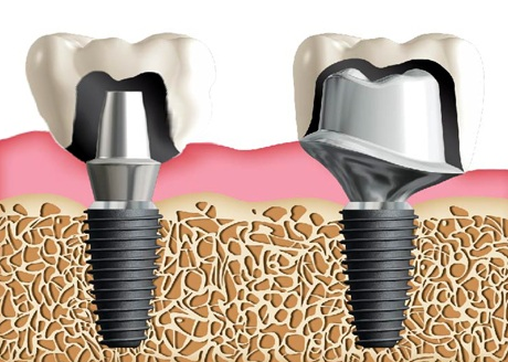custom_abutment.PNG